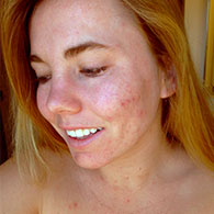 Before Treatment Image